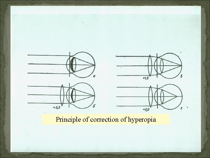 Principle of correction of hyperopia 