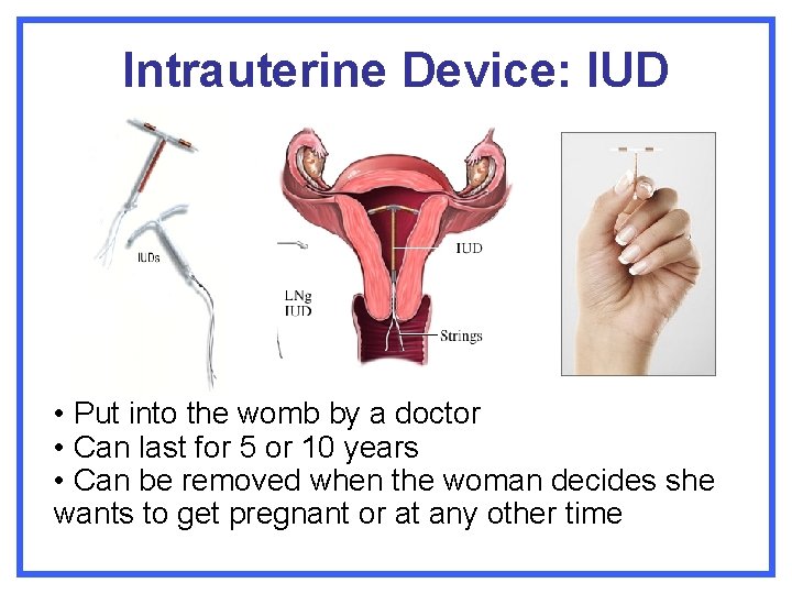 Intrauterine Device: IUD • Put into the womb by a doctor • Can last