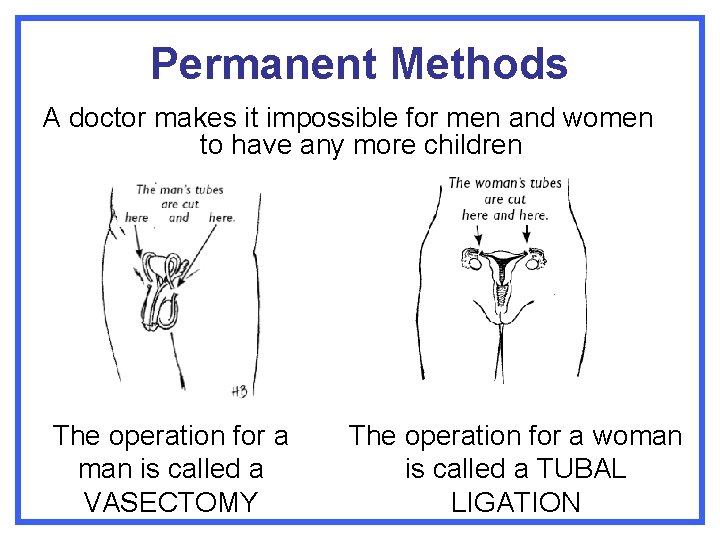 Permanent Methods A doctor makes it impossible for men and women to have any