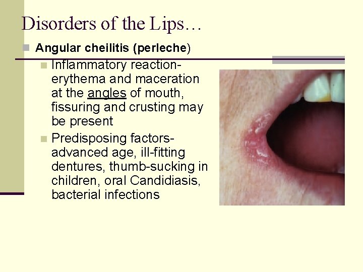 Disorders of the Lips… n Angular cheilitis (perleche) Inflammatory reactionerythema and maceration at the