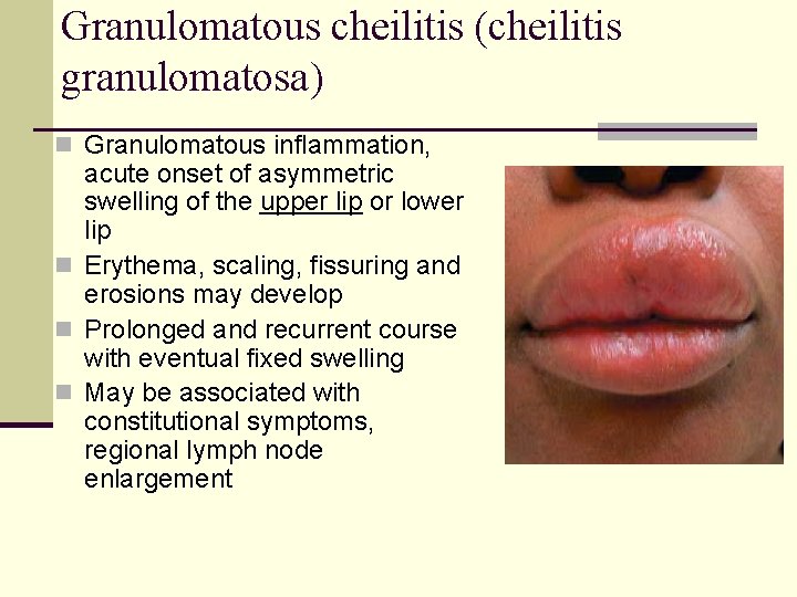 Granulomatous cheilitis (cheilitis granulomatosa) n Granulomatous inflammation, acute onset of asymmetric swelling of the