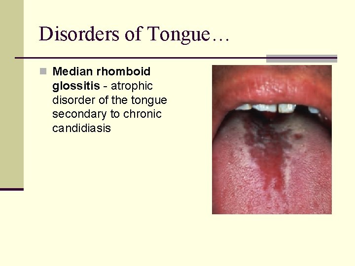 Disorders of Tongue… n Median rhomboid glossitis - atrophic disorder of the tongue secondary