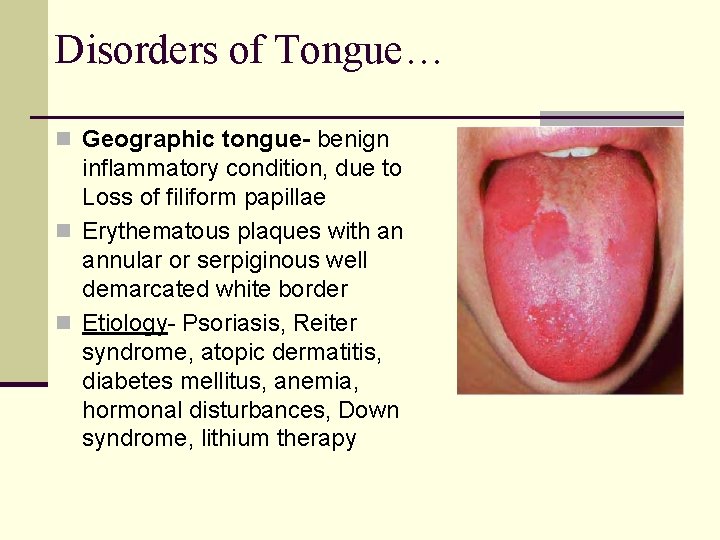 Disorders of Tongue… n Geographic tongue- benign inflammatory condition, due to Loss of filiform