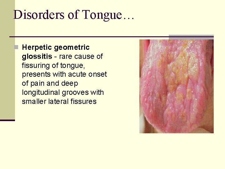 Disorders of Tongue… n Herpetic geometric glossitis - rare cause of fissuring of tongue,