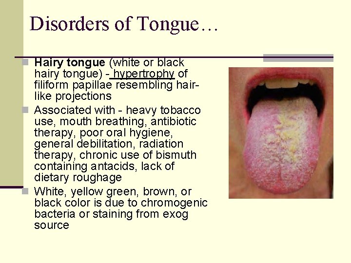 Disorders of Tongue… n Hairy tongue (white or black hairy tongue) - hypertrophy of