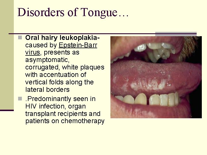 Disorders of Tongue… n Oral hairy leukoplakia- caused by Epstein-Barr virus, presents as asymptomatic,