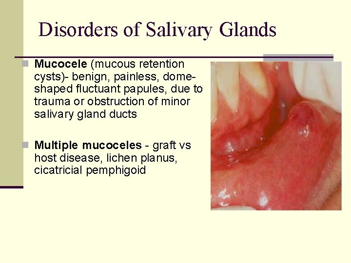 Disorders of Salivary Glands n Mucocele (mucous retention cysts)- benign, painless, domeshaped fluctuant papules,