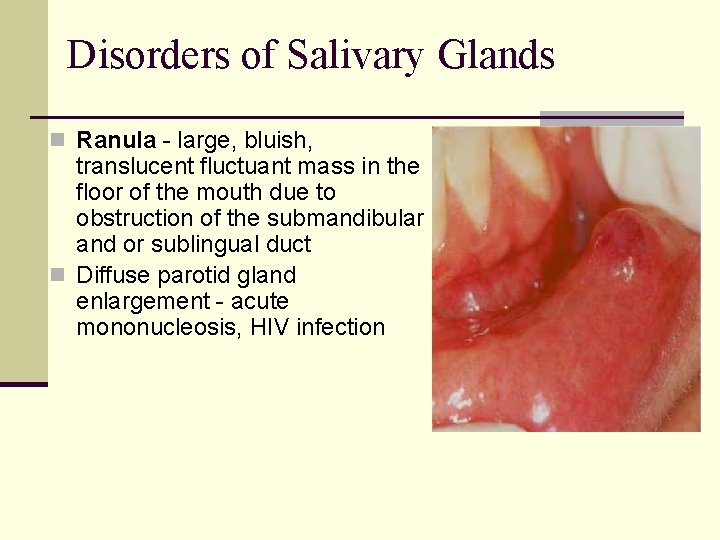Disorders of Salivary Glands n Ranula - large, bluish, translucent fluctuant mass in the