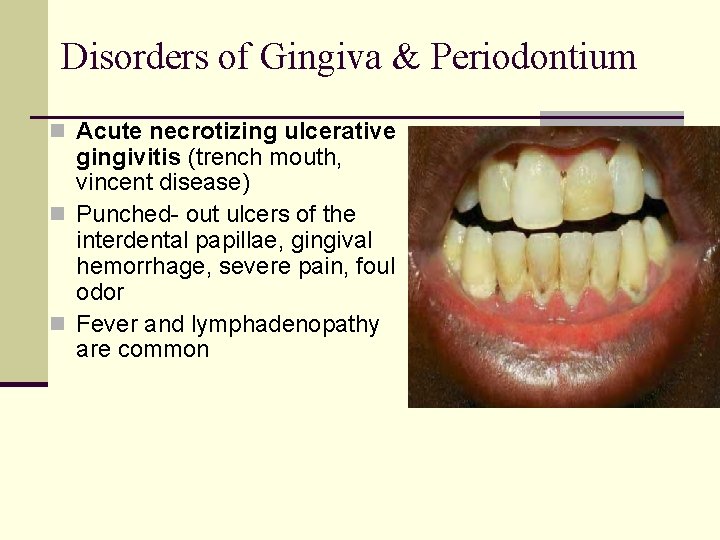Disorders of Gingiva & Periodontium n Acute necrotizing ulcerative gingivitis (trench mouth, vincent disease)