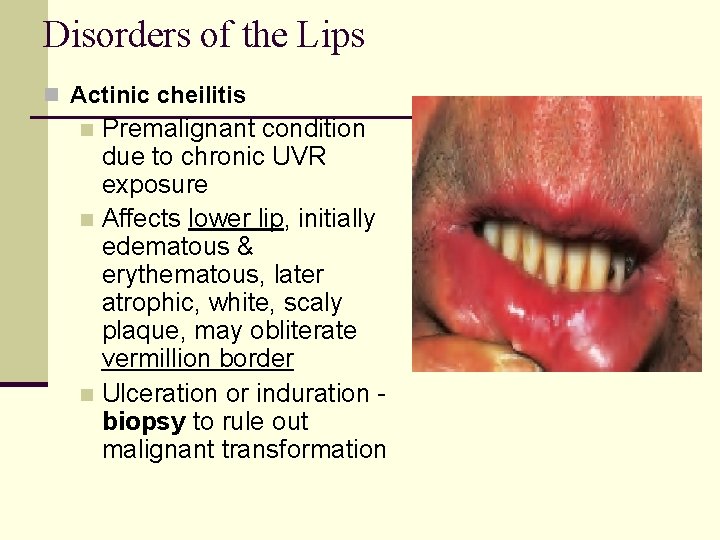 Disorders of the Lips n Actinic cheilitis Premalignant condition due to chronic UVR exposure