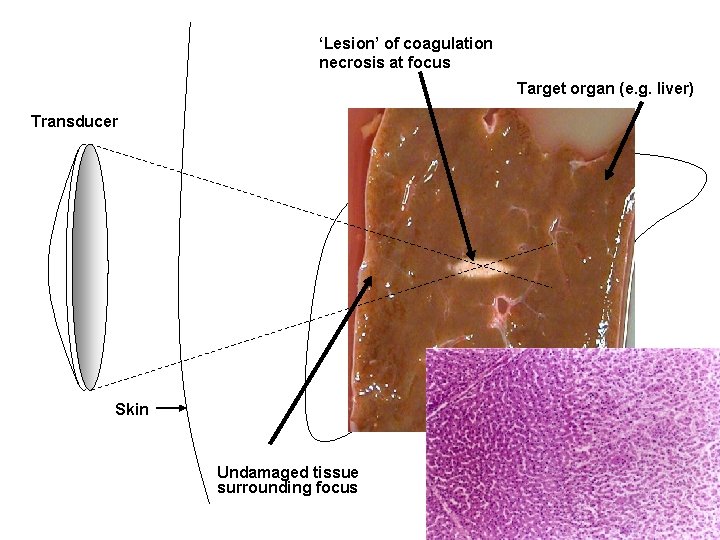 ‘Lesion’ of coagulation necrosis at focus Target organ (e. g. liver) Transducer Tumor Skin