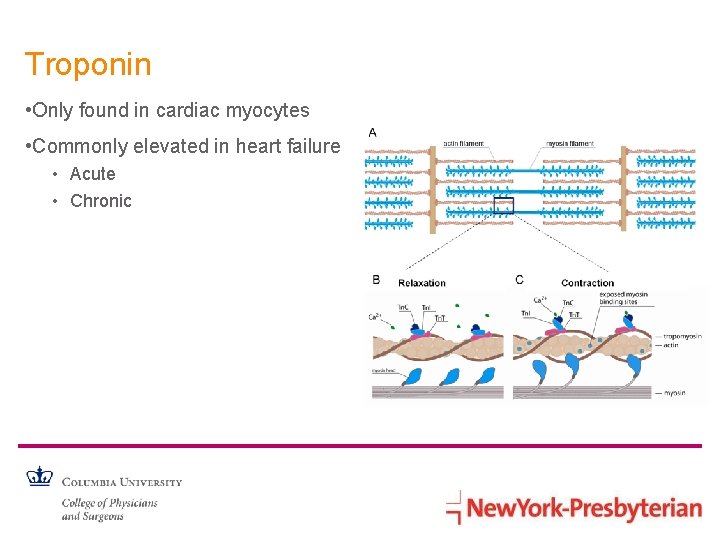 Troponin • Only found in cardiac myocytes • Commonly elevated in heart failure •