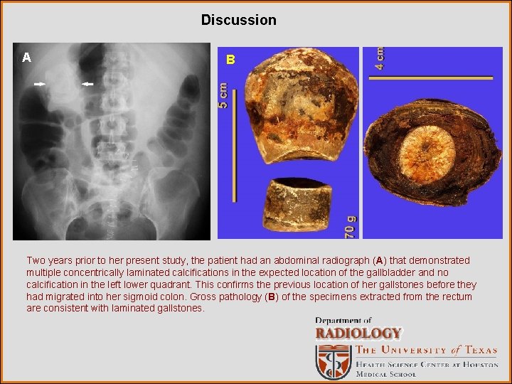 Discussion A B Two years prior to her present study, the patient had an