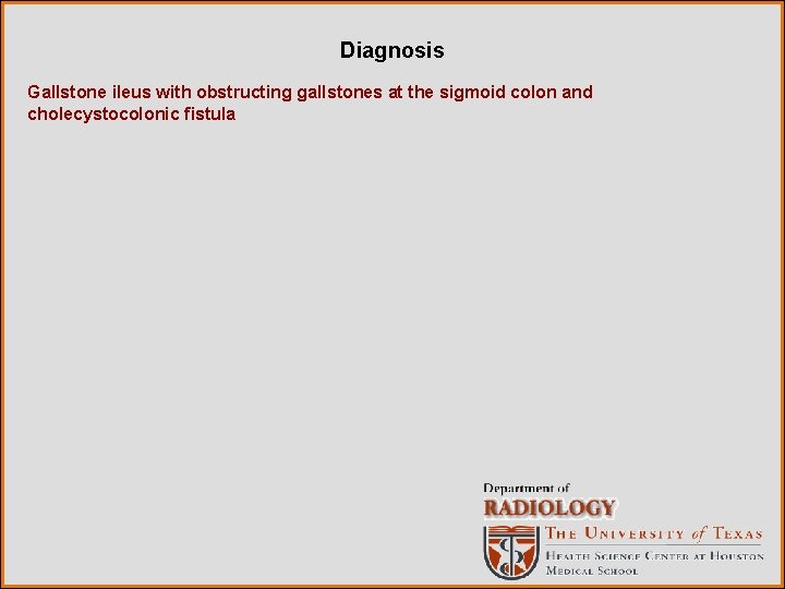 Diagnosis Gallstone ileus with obstructing gallstones at the sigmoid colon and cholecystocolonic fistula 