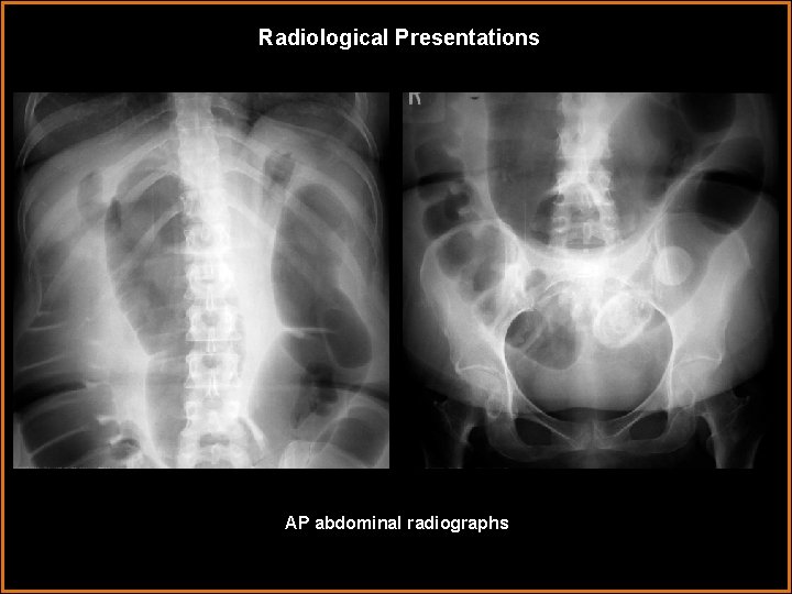 Radiological Presentations AP abdominal radiographs 