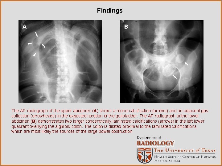 Findings A B The AP radiograph of the upper abdomen (A) shows a round