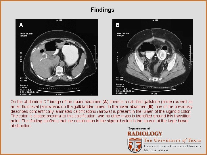 Findings A B On the abdominal CT image of the upper abdomen (A), there