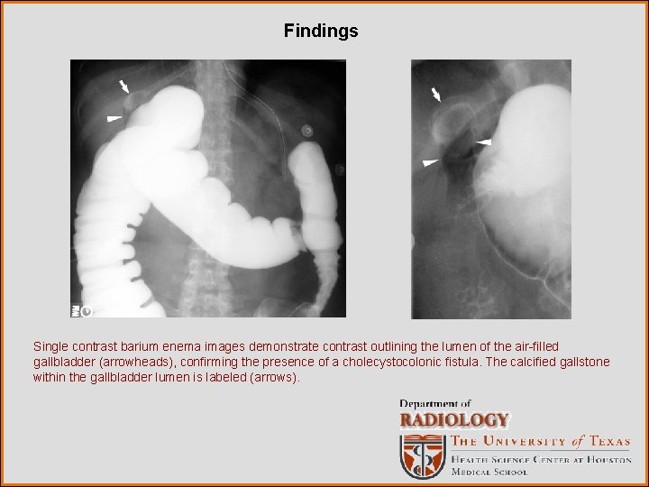 Findings Single contrast barium enema images demonstrate contrast outlining the lumen of the air-filled