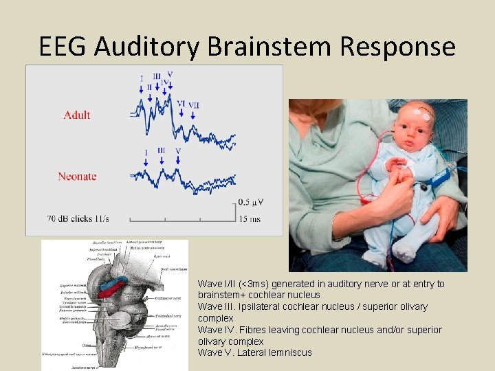 EEG Auditory Brainstem Response Wave I/II (<3 ms) generated in auditory nerve or at