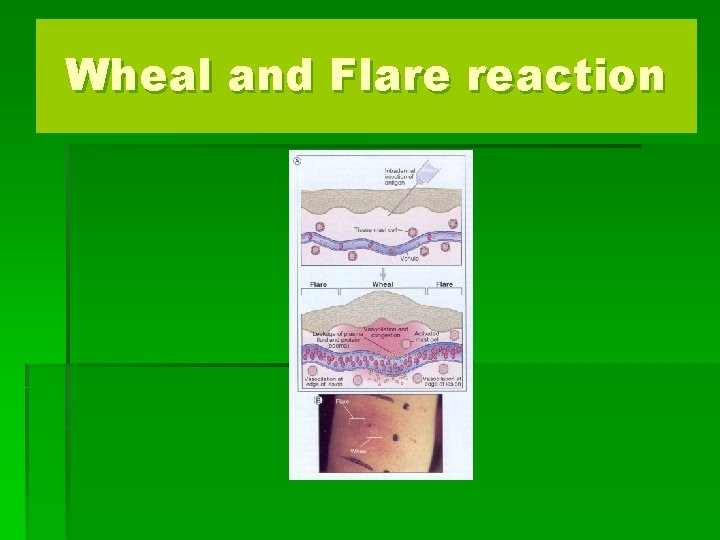 Wheal and Flare reaction 