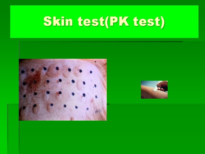 Skin test(PK test) 