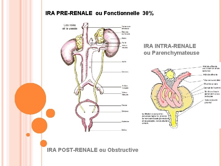 IRA PRE-RENALE ou Fonctionnelle 30% IRA INTRA-RENALE ou Parenchymateuse IRA POST-RENALE ou Obstructive 