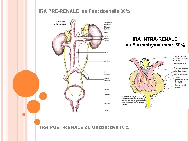 IRA PRE-RENALE ou Fonctionnelle 30% IRA INTRA-RENALE ou Parenchymateuse 60% IRA POST-RENALE ou Obstructive