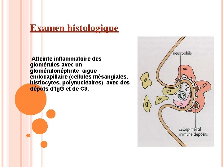 Examen histologique Atteinte inflammatoire des glomérules avec un glomérulonéphrite aiguë endocapillaire (cellules mésangiales, histiocytes,