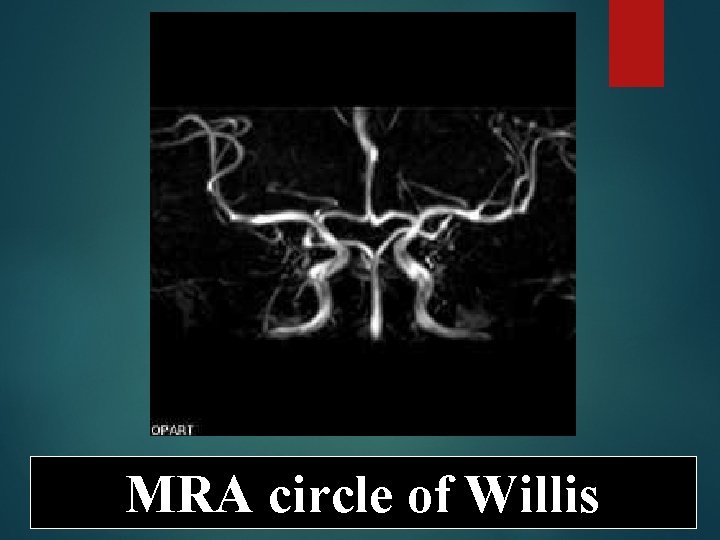 MRA circle of Willis 
