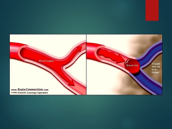 Normal blood flow Thrombosis Artery Blood supply Blood clot Oxygen starved brain tissue 