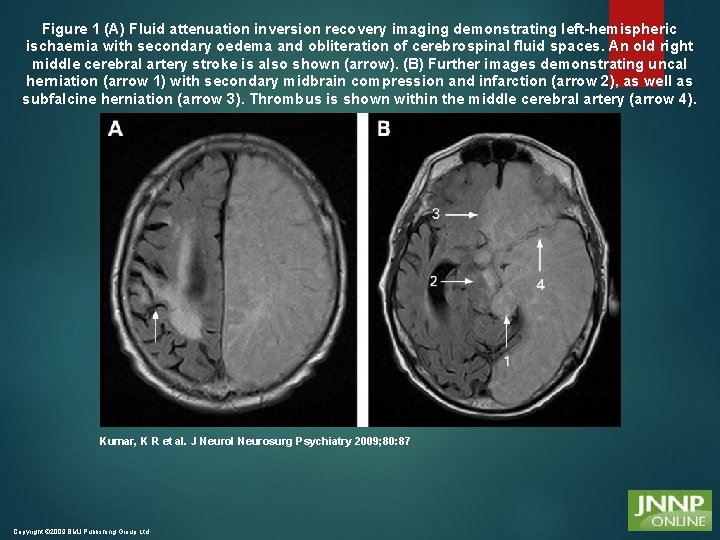 Figure 1 (A) Fluid attenuation inversion recovery imaging demonstrating left-hemispheric ischaemia with secondary oedema