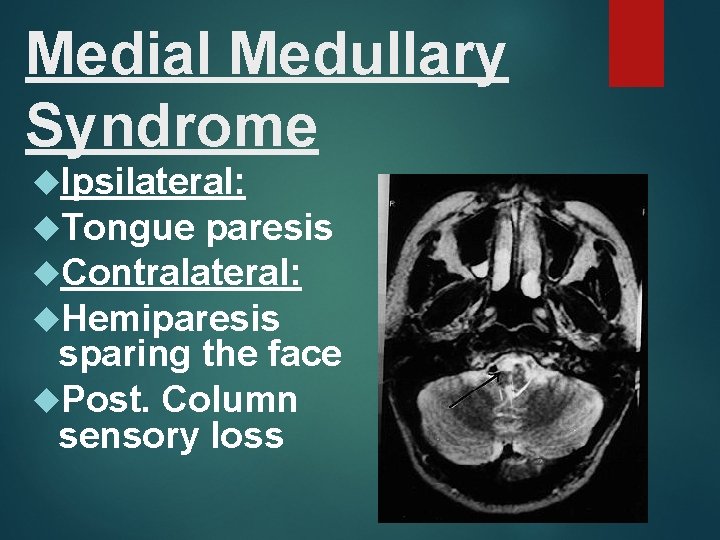 Medial Medullary Syndrome Ipsilateral: Tongue paresis Contralateral: Hemiparesis sparing the face Post. Column sensory