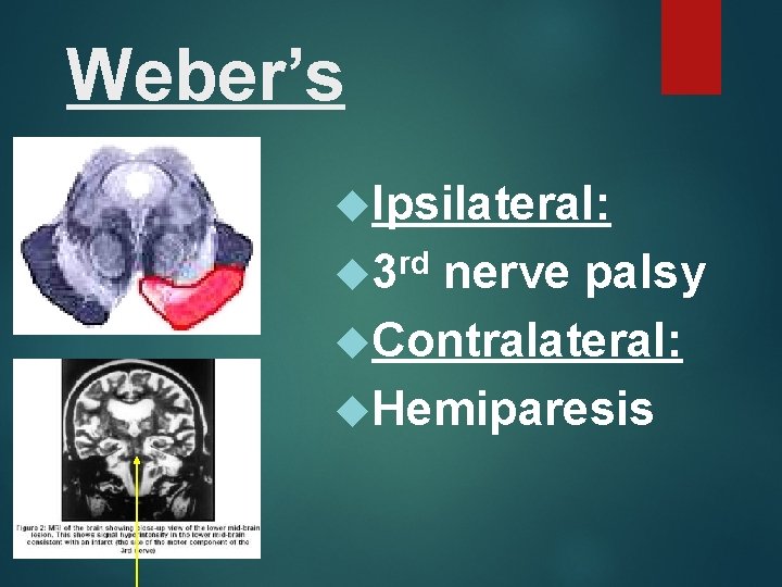 Weber’s Ipsilateral: rd 3 nerve palsy Contralateral: Hemiparesis 