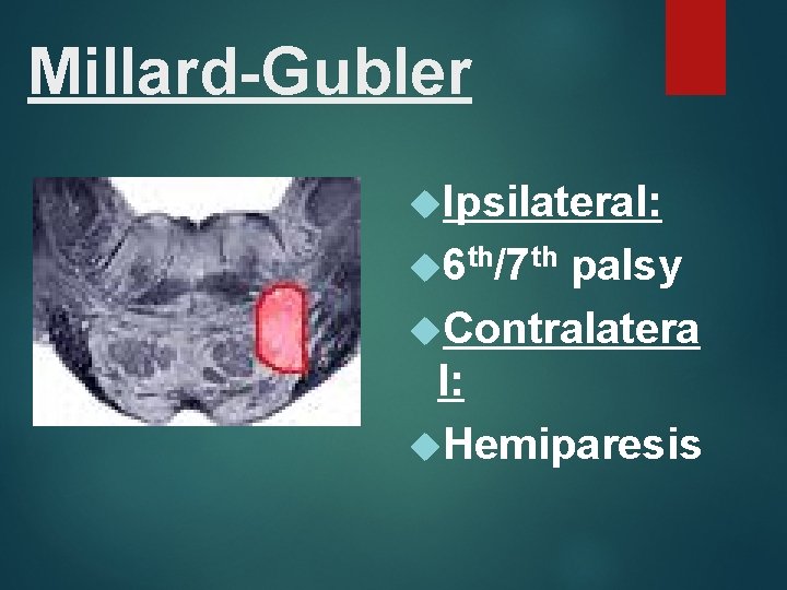 Millard-Gubler Ipsilateral: 6 th/7 th palsy Contralatera l: Hemiparesis 