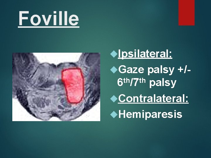 Foville Ipsilateral: Gaze palsy +/6 th/7 th palsy Contralateral: Hemiparesis 