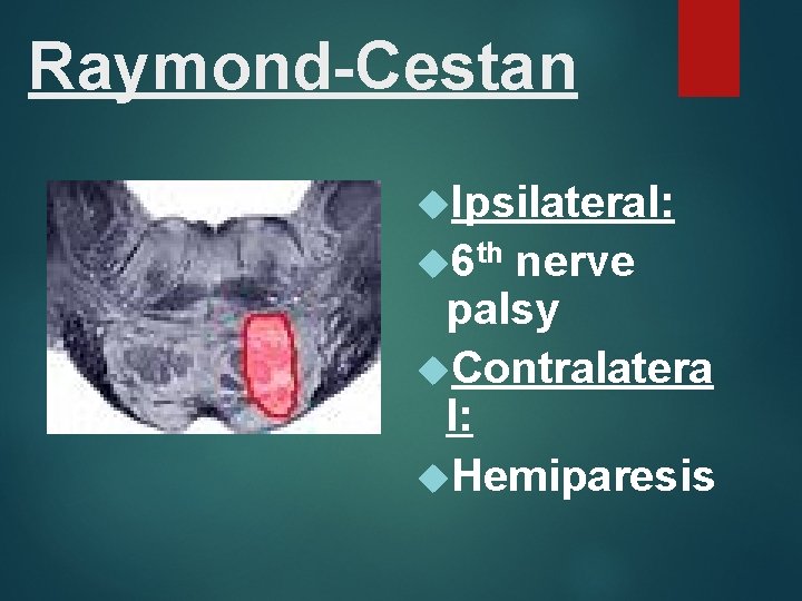 Raymond-Cestan Ipsilateral: 6 th nerve palsy Contralatera l: Hemiparesis 