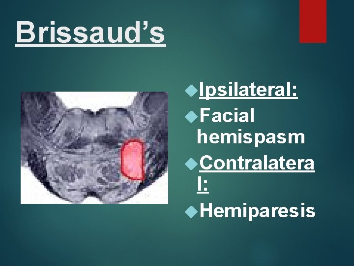 Brissaud’s Ipsilateral: Facial hemispasm Contralatera l: Hemiparesis 