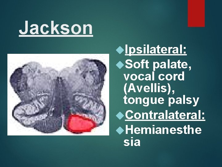 Jackson Ipsilateral: Soft palate, vocal cord (Avellis), tongue palsy Contralateral: Hemianesthe sia 