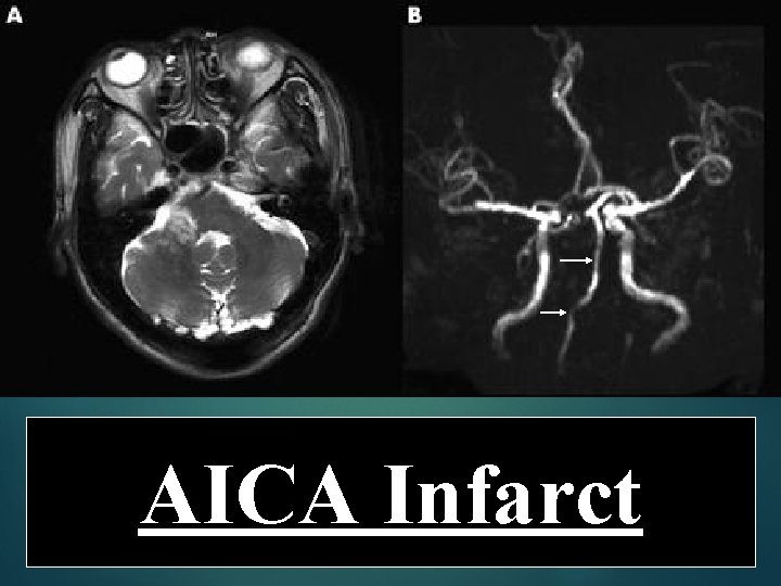 AICA Infarct 