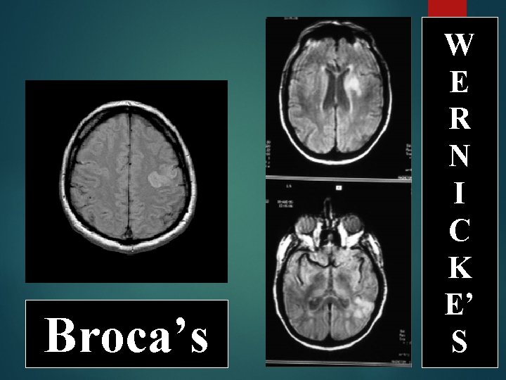 Broca’s W E R N I C K E’ S 