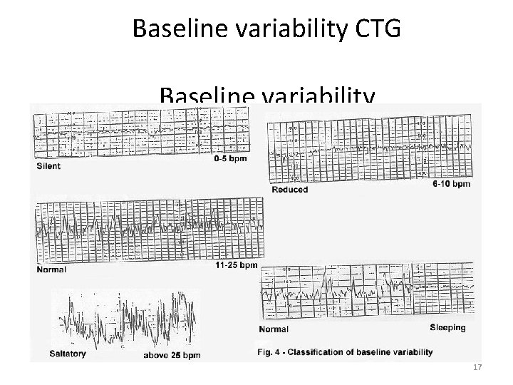 Baseline variability CTG Baseline variability 17 