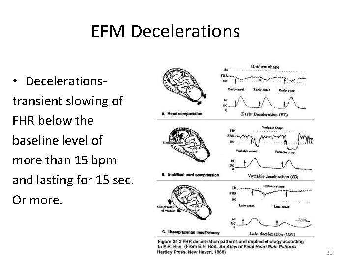 EFM Decelerations • Decelerationstransient slowing of FHR below the baseline level of more than