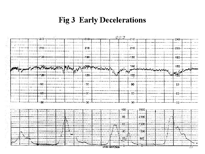 Fig 3 Early Decelerations 23 