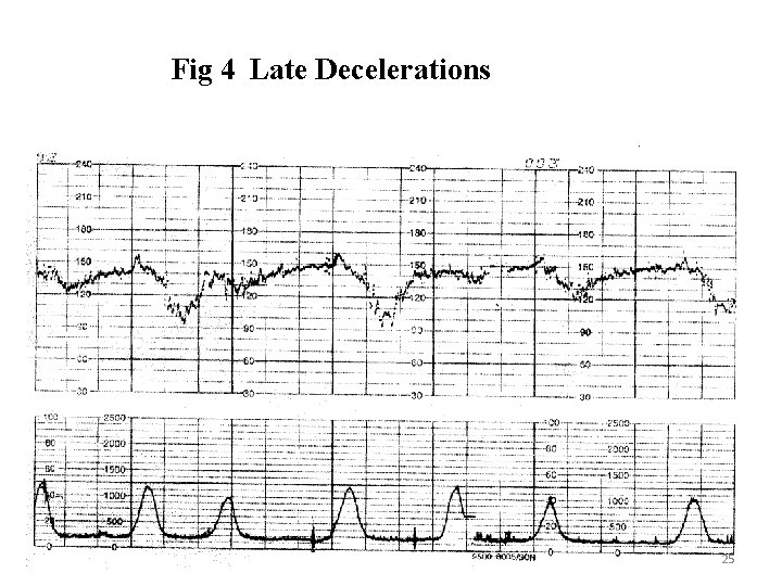 Fig 4 Late Decelerations 25 