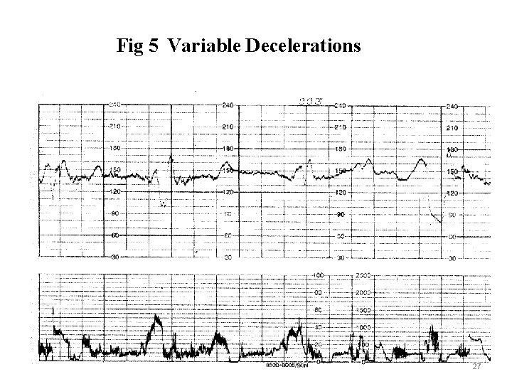 Fig 5 Variable Decelerations 27 