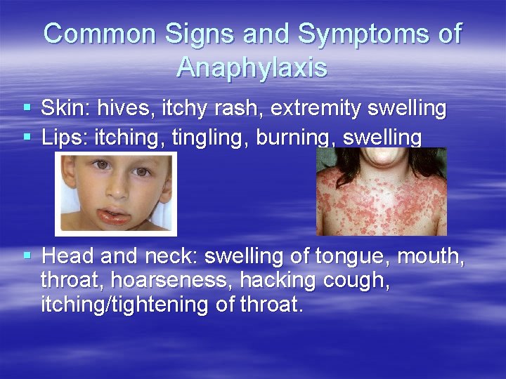 Common Signs and Symptoms of Anaphylaxis § Skin: hives, itchy rash, extremity swelling § Common Signs and Symptoms of Anaphylaxis § Skin: hives, itchy rash, extremity swelling §