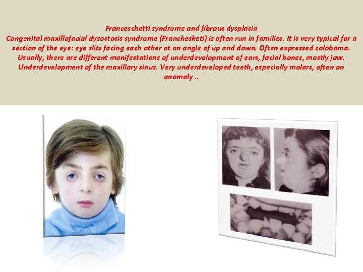 Franceschetti syndrome and fibrous dysplasia Congenital maxillofacial dysostosis syndrome (Franchesketi) is often run in