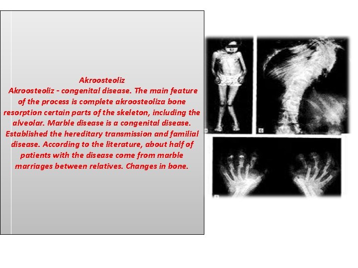 Akroosteoliz - congenital disease. The main feature of the process is complete akroosteoliza bone