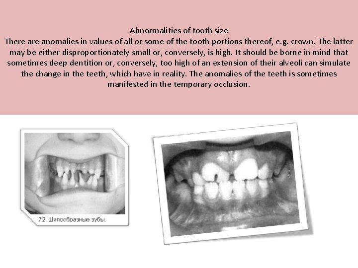 Abnormalities of tooth size There anomalies in values of all or some of the