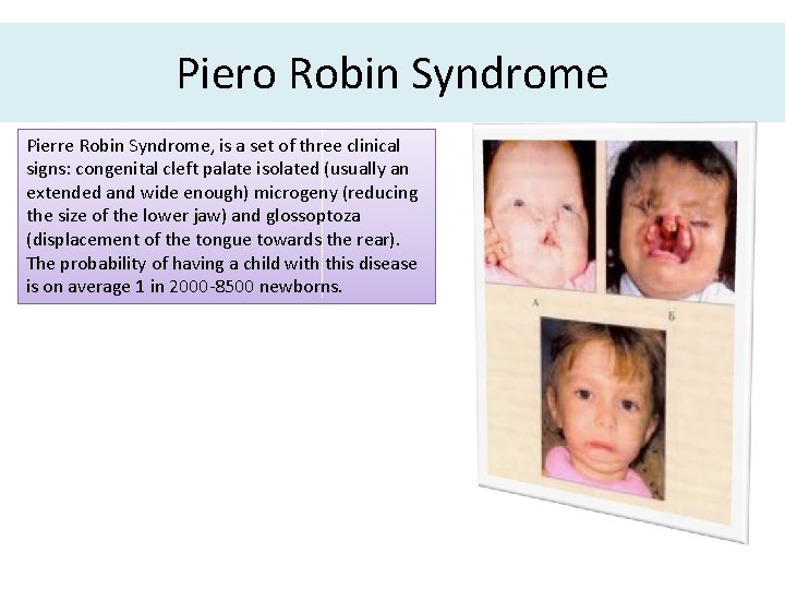 Piero Robin Syndrome Pierre Robin Syndrome, is a set of three clinical signs: congenital